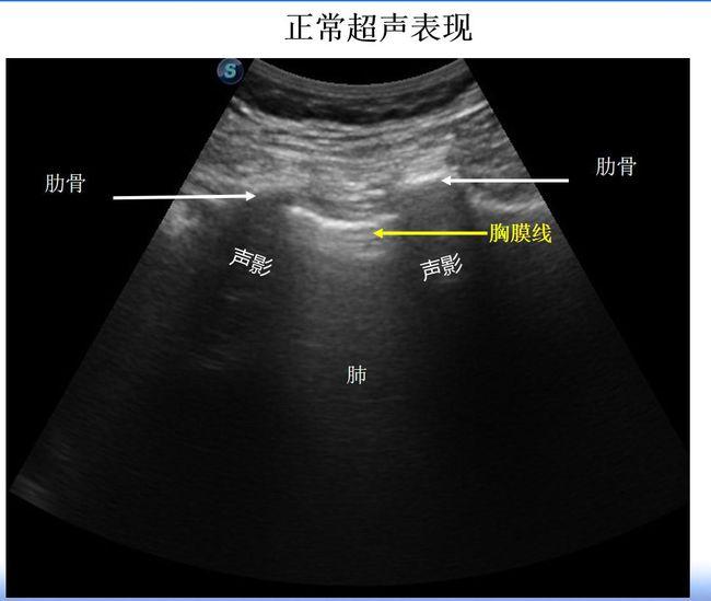 从临床到实验室肺部超声对肺水肿动物模型的评估