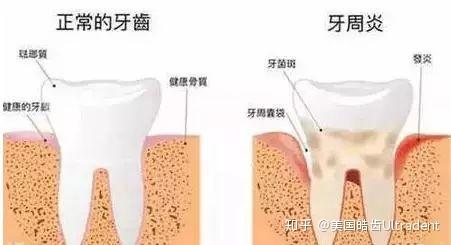 主要表现为牙龈出血