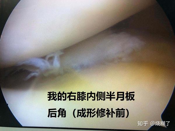 一个无症状右膝内侧半月板后角3度损伤大叔的手术及康复之路(1)