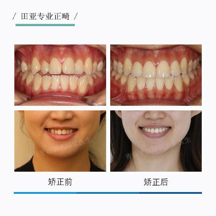 经过检查,发现患者尖牙段及前磨牙段牙弓狭窄,后牙咬合早接触,直面型
