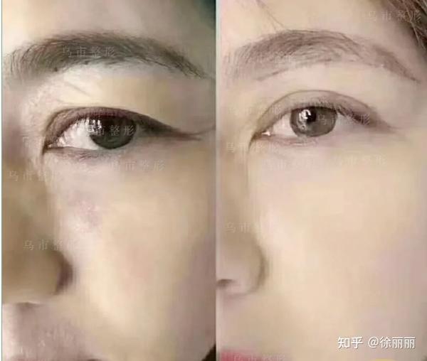年纪越大眼皮越松垂怎么办?