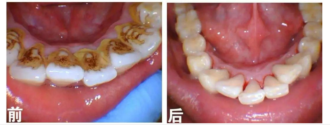 做人诚信为本  牙结石又称牙石,它是由食物残渣,坏死脱落的口腔上皮