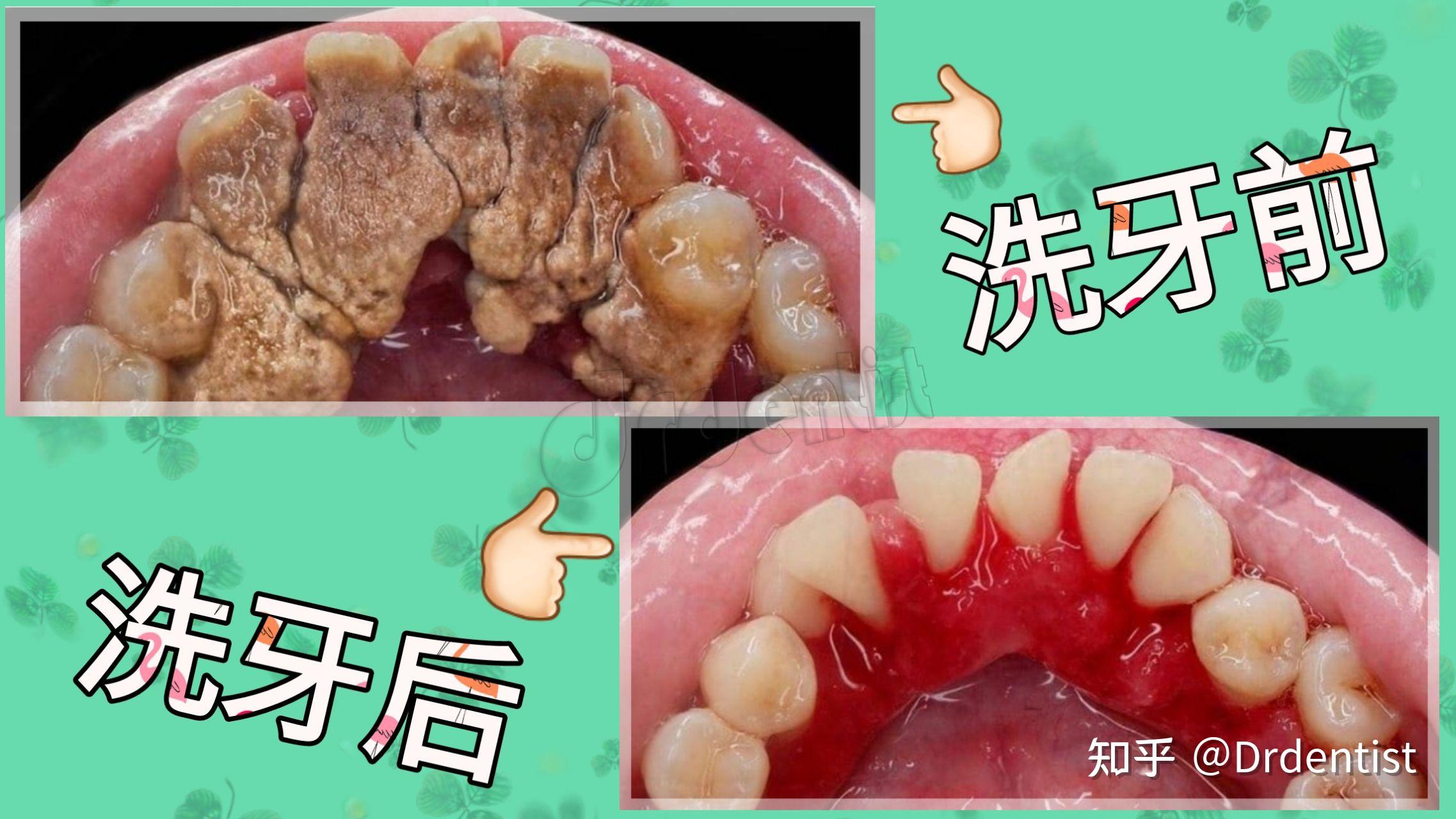 洗牙的过程是怎样的洗牙后有哪些需要注意的