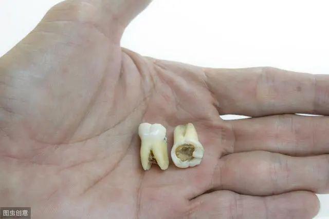 比如蛀牙发展到整个牙都空了,发黑变臭,或者外伤导致牙齿折断,劈裂