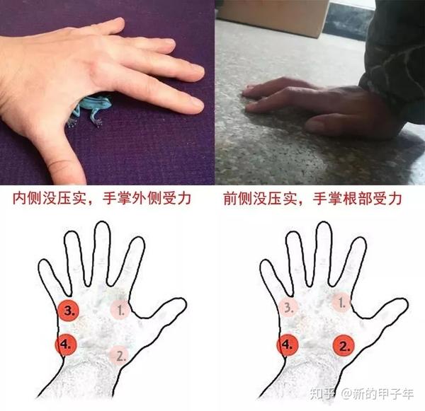 腕管综合征(鼠标手)的人越来越多,你是其中一员么?