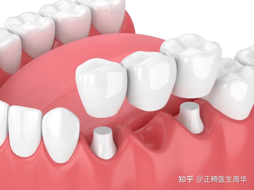 人民日报:牙齿缺失会折寿10年!缺牙的后果比你想象中严重!