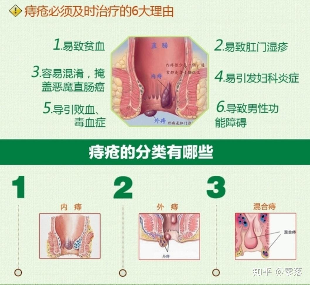 内痔不能自愈吗