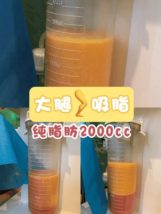 案例分享大腿吸脂纯脂肪近2000cc