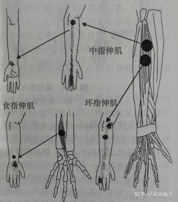 读书笔记指伸肌触发点