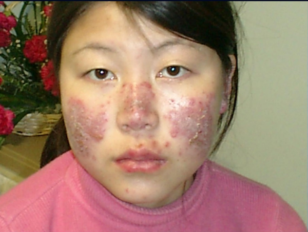 虽然很多临床调查证实,红斑狼疮患者终生出现皮肤改变(无论是狼疮特异