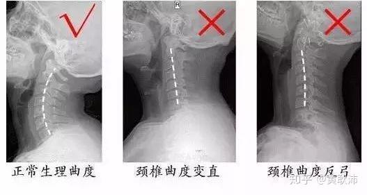 颈椎反弓越来越常见严重还会引起瘫痪