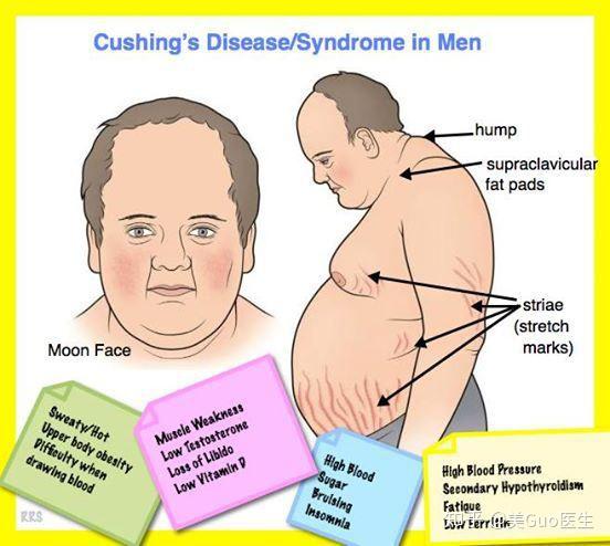 acth腺瘤可引起cushing综合征,表现为满月脸,向心性