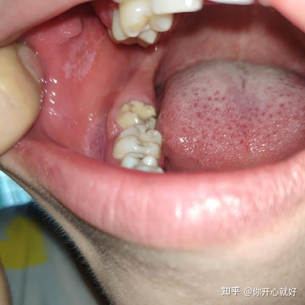 赶紧照照镜子,才发现牙龈底部居然一片白斑,百度说这可能是口腔癌前