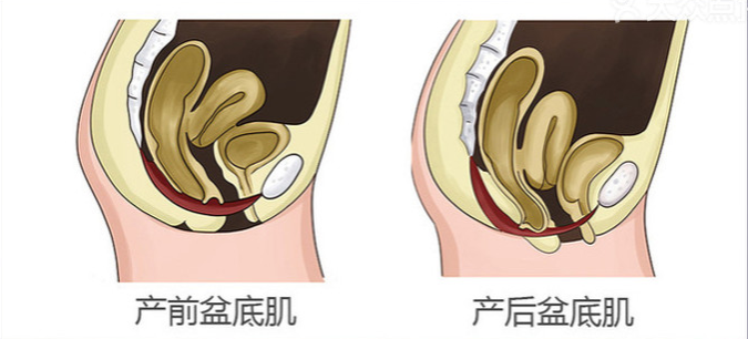 产后为什么要做盆底肌修复治疗