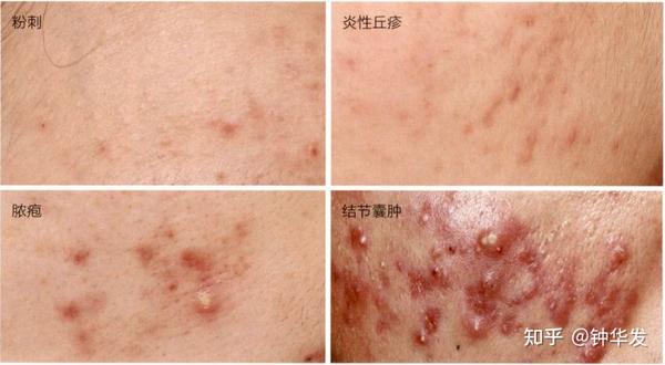 痤疮的皮疹类型表现