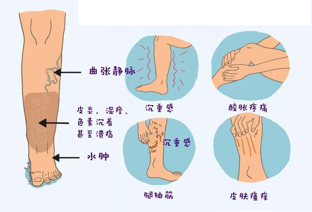 医生我的静脉曲张严重吗