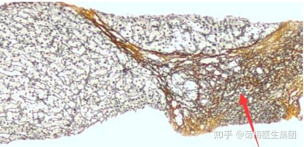 图2:网状纤维染色后肝内可评估纤维化程度   3.