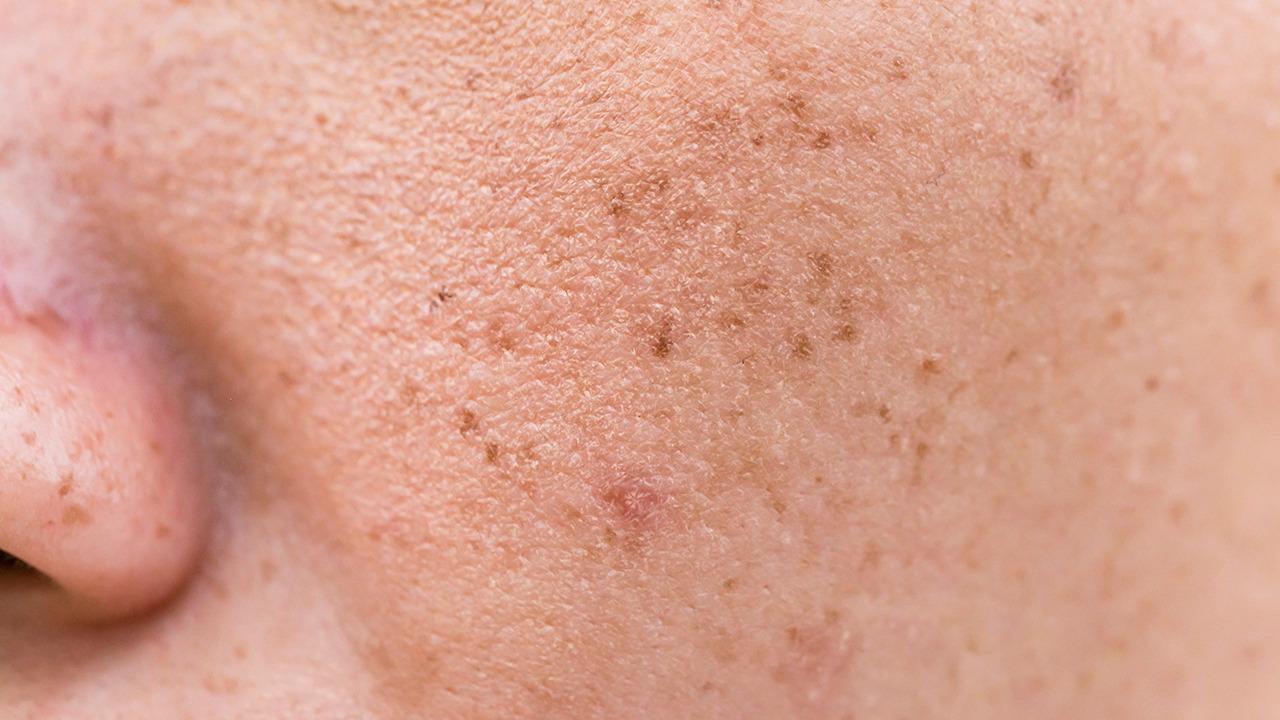 雅镁化妆品丨皮肤为什么会长斑