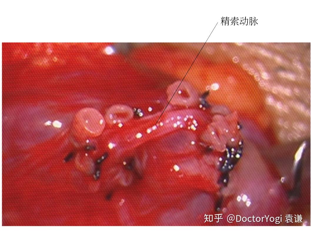 精索是睾丸的"生命线",里面不仅有供应睾丸的血管,也有将精子运出