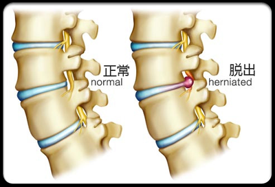 中重度腰椎间盘突出半年治愈-纯干货分享