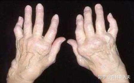 75岁的老奶奶手指扭曲变形,注意这六点,远离类风湿关节炎!