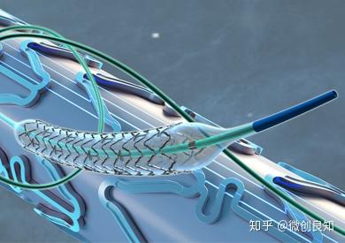 心脏支架系列:要不要装心脏支架到底谁说了算?