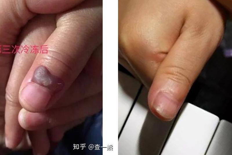 【甲周疣】5岁幼童冷冻3次未愈.到4个月恢复如初