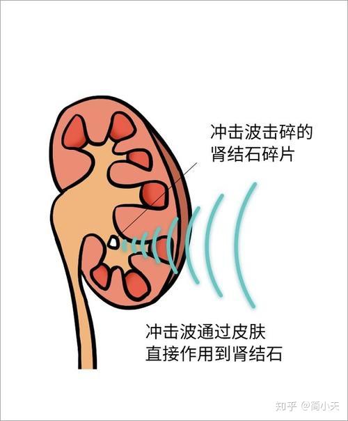 肾结石怎么排出?肾下盏结石3招快速排出