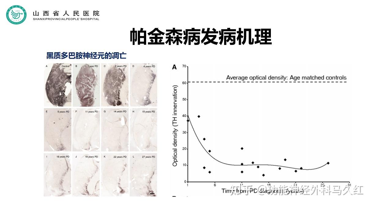 知帕不怕专家教您和帕金森病友好相处