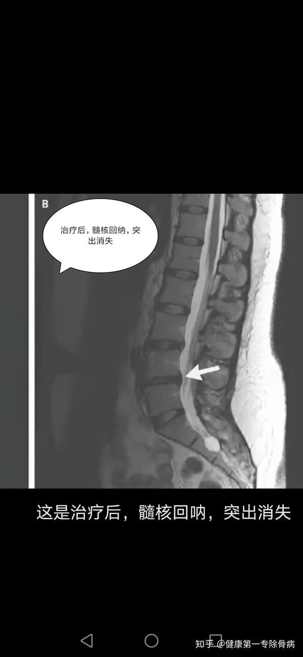 突出椎管狭窄保守康复好,拍片对比