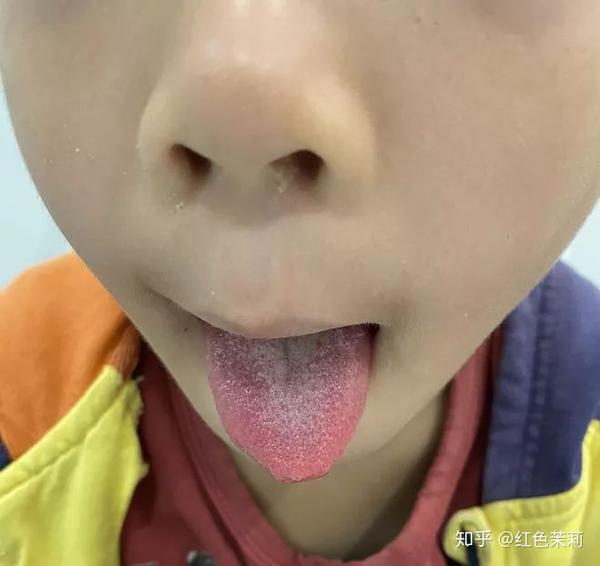 舌苔如图三,舌红,苔不厚,嗓子是红的,嗓子疼,此时选择小儿肺热咳喘