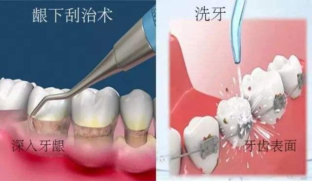 2 人 赞同了该文章   洗牙和龈下刮治   牙结石怎么去除,去除了还会有