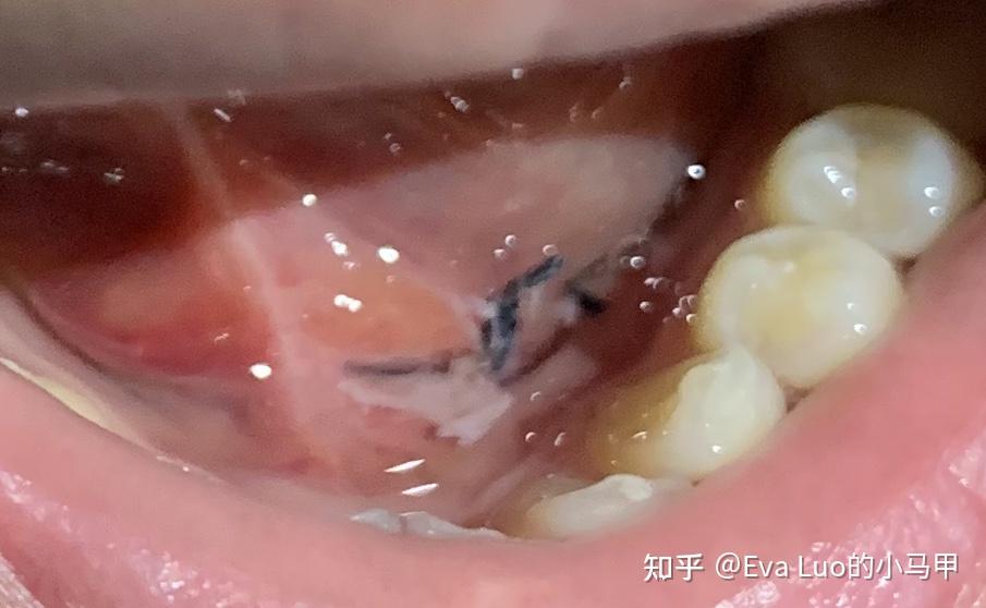 舌下腺囊肿的治疗方法