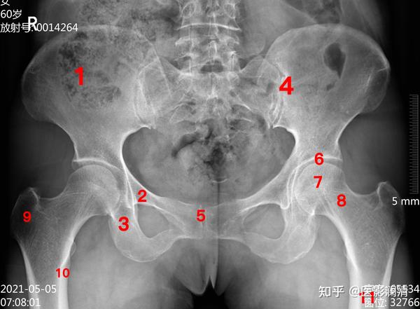 股骨干 x线表现:骨盆由两侧的髋骨和后方的骶尾骨组成.
