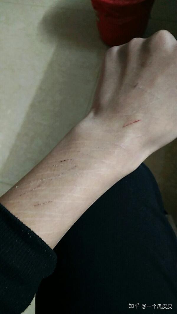 不危及生命的自残算是合理的宣泄方式吗?
