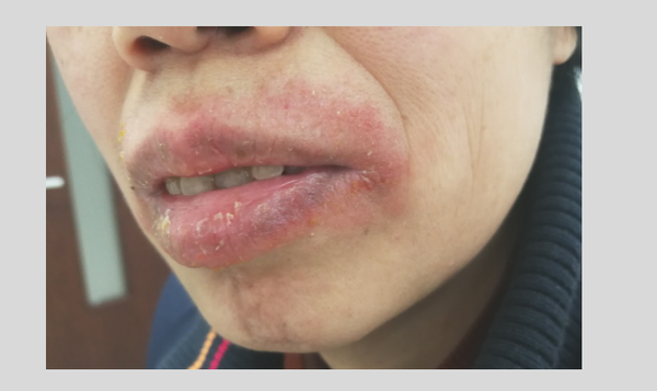 海得宝冷敷凝胶-临床案例分享 | 57岁女性-唇炎,1周效果展示