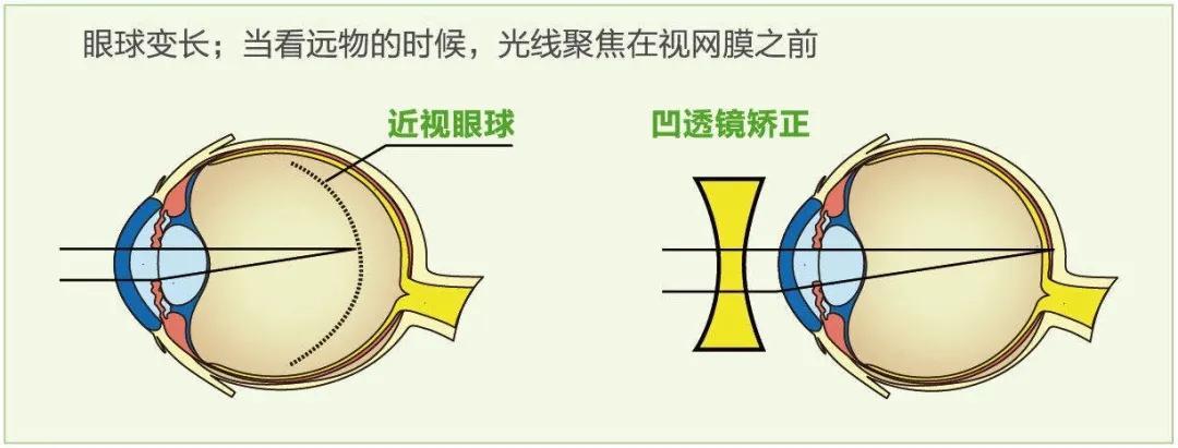 近视手术"加法"or"减法",到底怎么选?