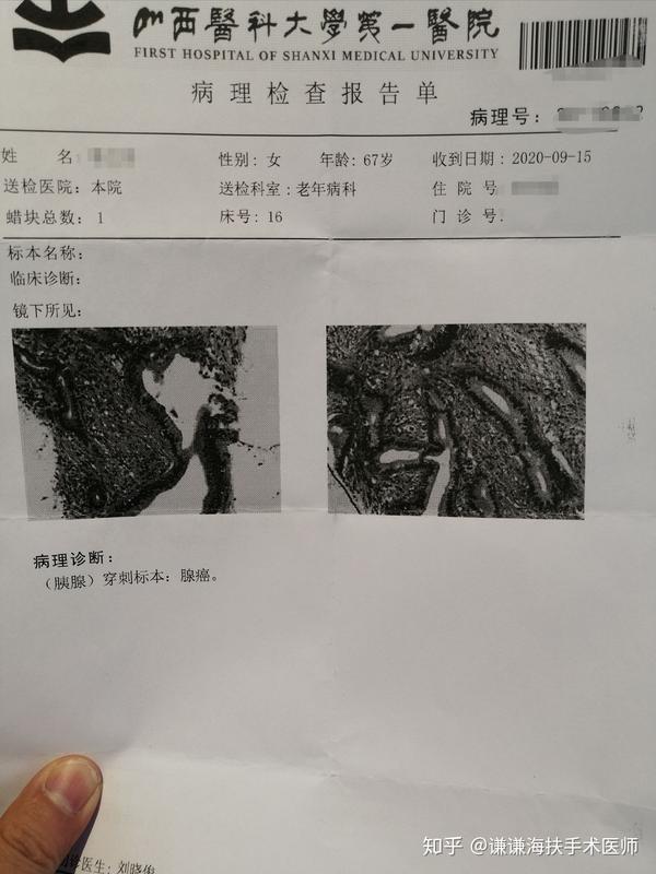 晚期胰腺癌诊治病例分享
