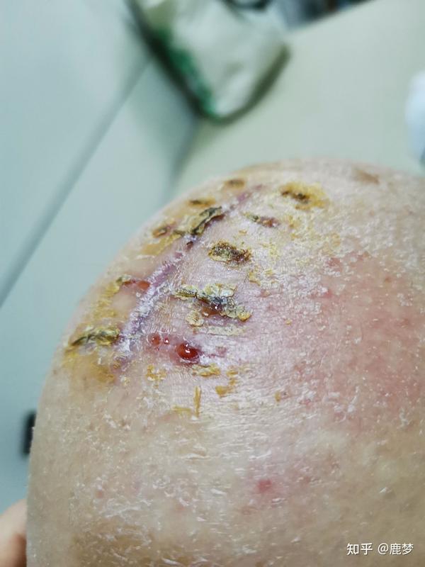 这是术后一个半月,过敏情况好转了,线结反应也慢慢好了