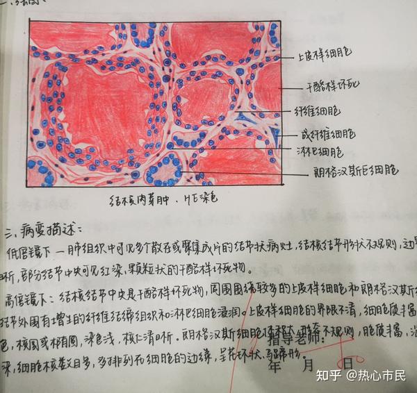 病理学红蓝铅笔手绘图实验报告病变描述
