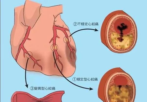 心肌桥是个什么心脏病?都没事?医生辟谣:也可能引发心肌梗死