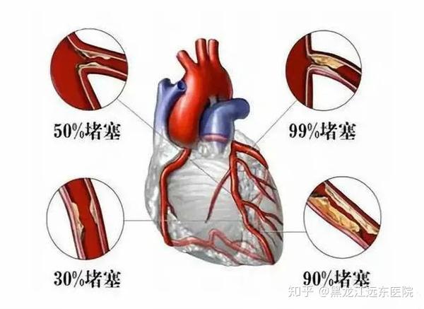心脏血管狭窄程度75,必须放支架才能治疗吗?医生告诉您答案!