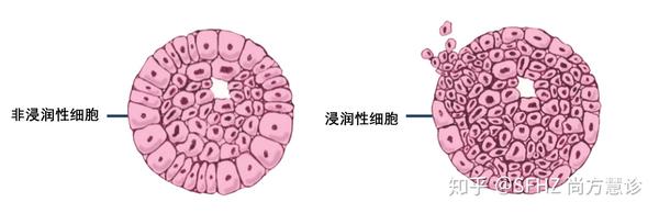 一文读懂乳腺癌的病理报告 知乎