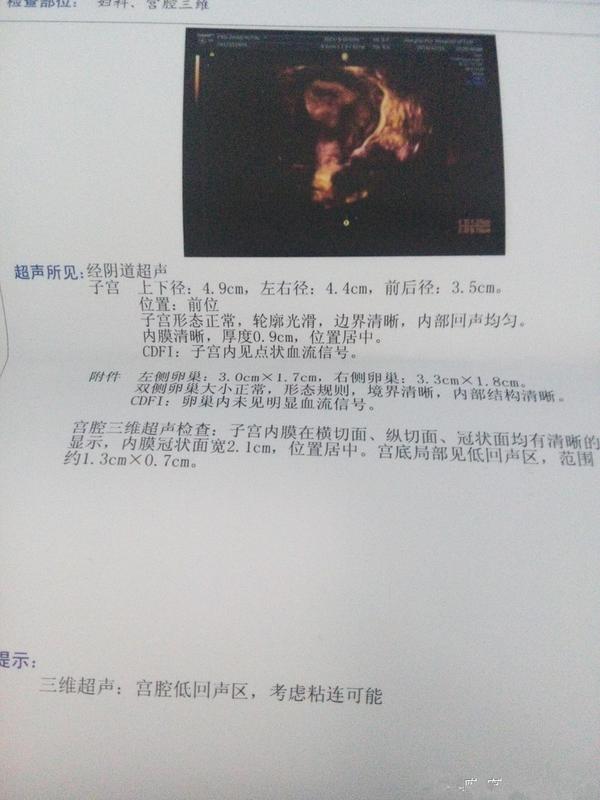 宫腔粘连怎么办呢?可以治好吗?