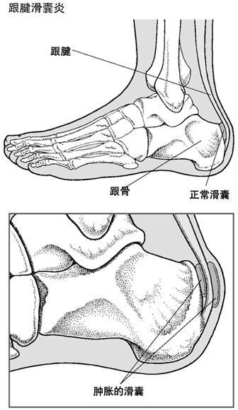 这个痛点(红色区域)是跟腱的后滑囊位置,发病率相对来讲跑者的发病率