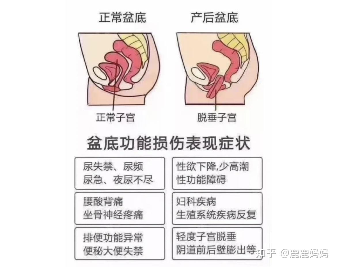 帮助修复盆底肌松弛,改善产后漏尿和膨出,脱垂的问题