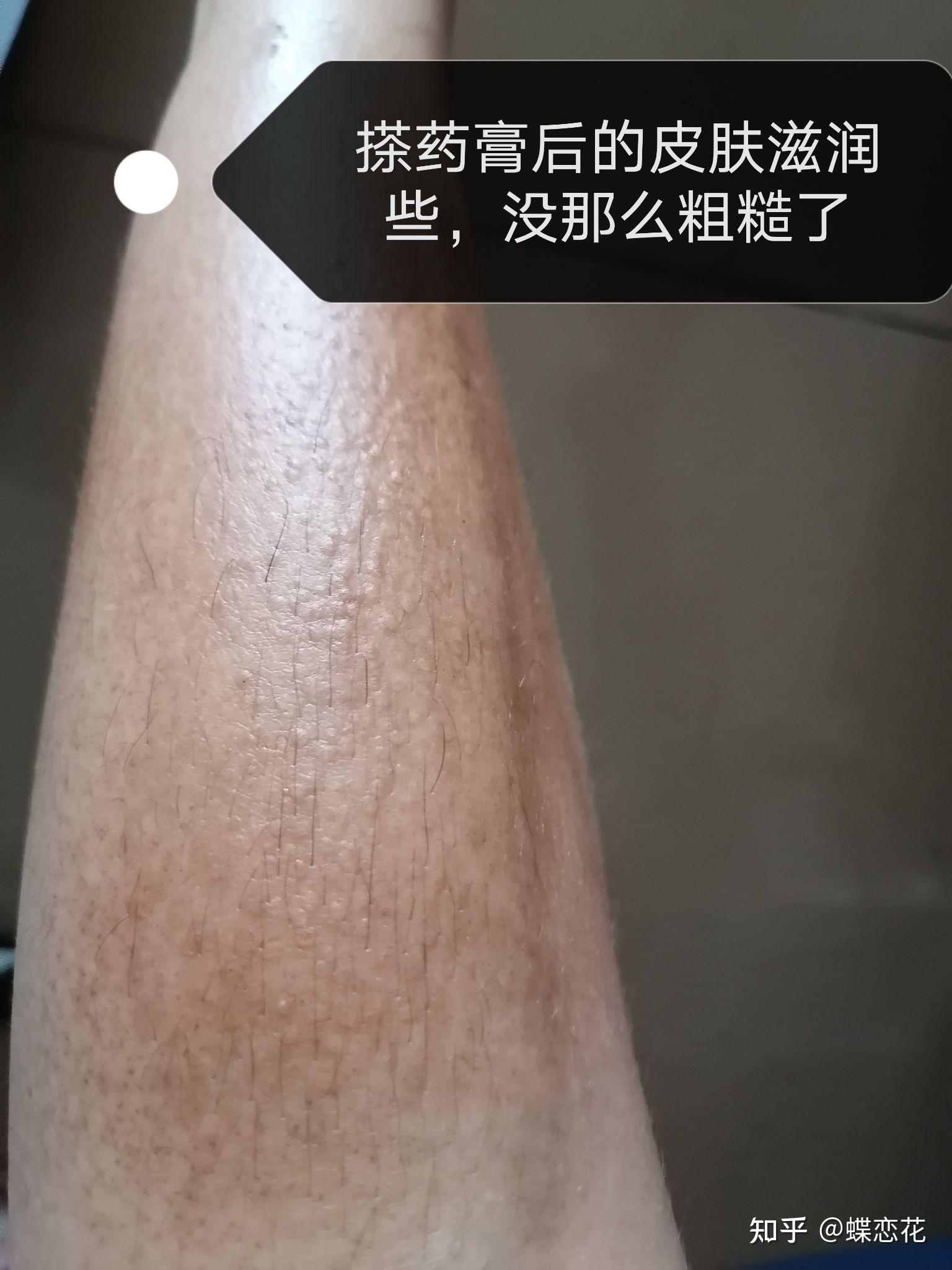 皮肤淀粉样变真的没办法治好吗告诉你能治好