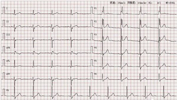 心电图图库丨完全性右束支阻滞系列