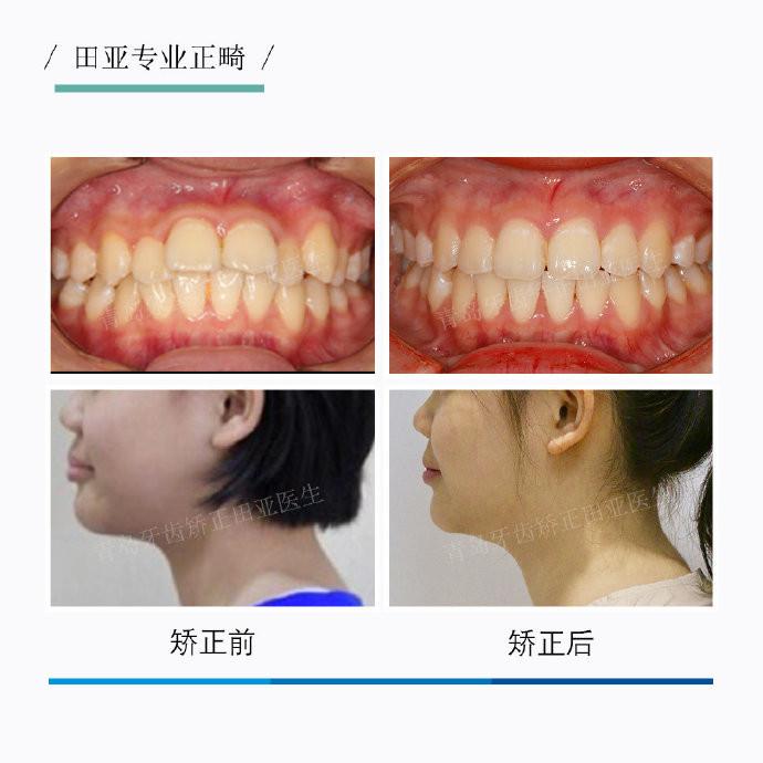 青岛牙齿矫正深覆合深覆盖正畸案例