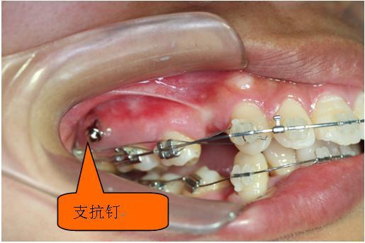 牙齿矫正竟然需要骨头上打钉子